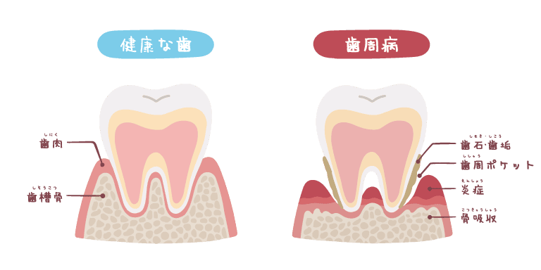 健康な歯と歯周病のイメージイラスト