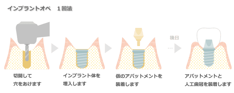 インプラント手術のイメージイラスト